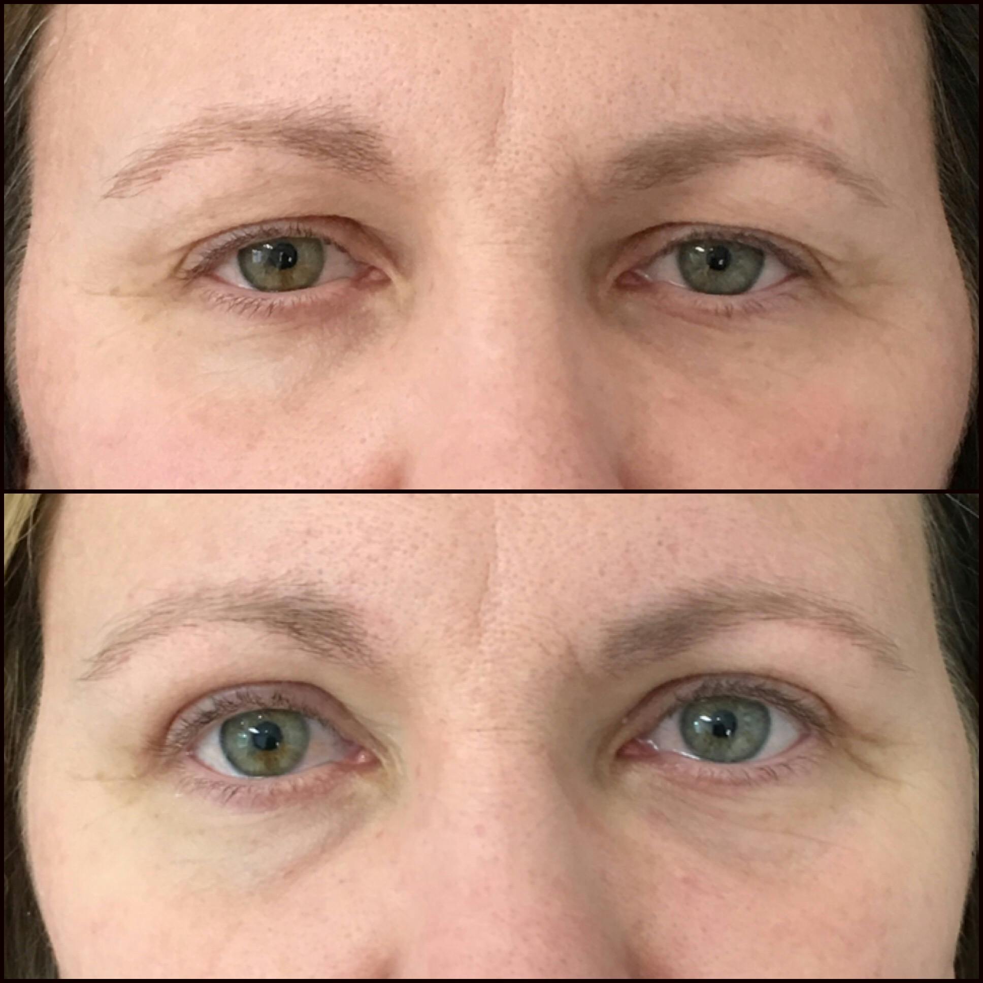 Upper Blepharoplasty Before & After Gallery - Patient 54385621 - Image 1