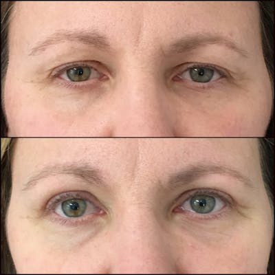 Upper Blepharoplasty Before & After Gallery - Patient 54385621 - Image 1