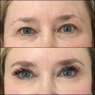 Upper Blepharoplasty Before & After Gallery - Patient 54385622 - Image 1