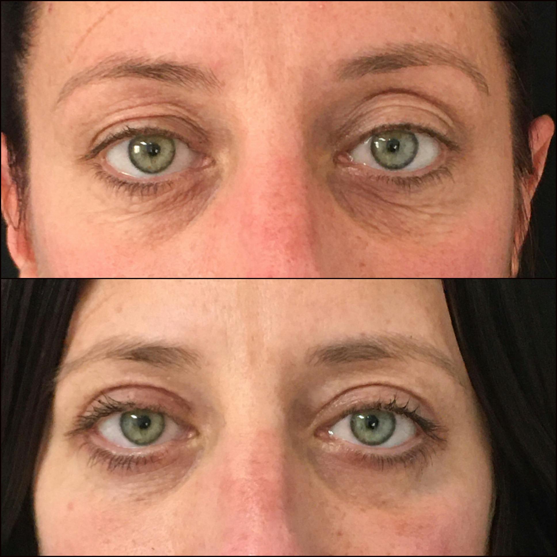 Upper Blepharoplasty Before & After Gallery - Patient 54385623 - Image 1