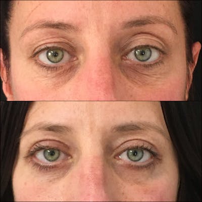 Upper Blepharoplasty Before & After Gallery - Patient 54385623 - Image 1