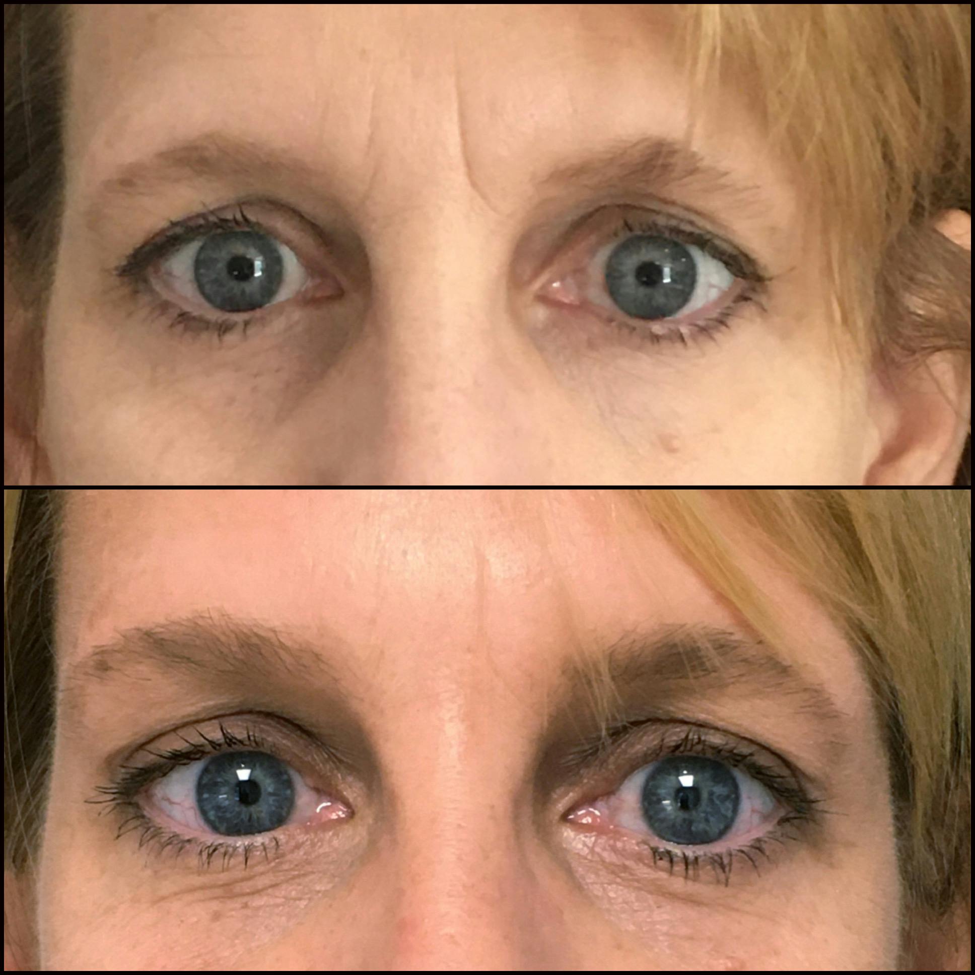 Brow Lift Before & After Gallery - Patient 54836775 - Image 1