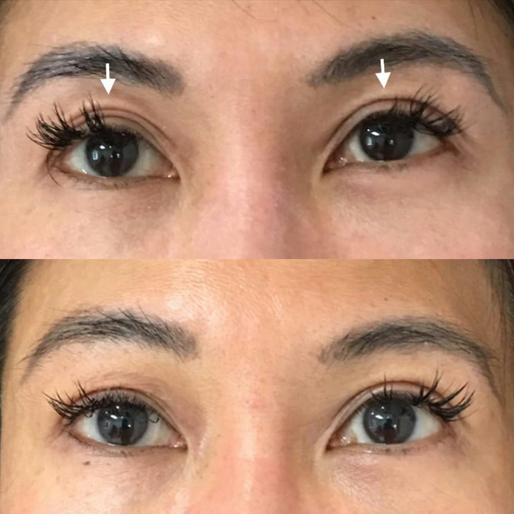 Eyelid Filler Before & After Gallery - Patient 54031168 - Image 1