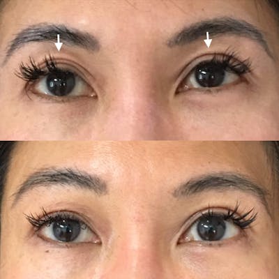 Eyelid Filler Before & After Gallery - Patient 54031168 - Image 1