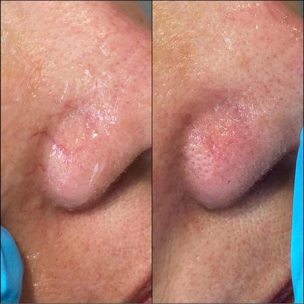 Under Eye Vein Treatment Before & After Gallery - Patient 55260492 - Image 1