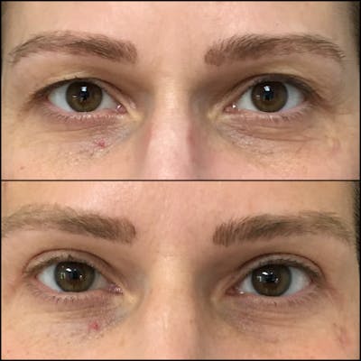 Upper Blepharoplasty Before & After Gallery - Patient 56142587 - Image 1