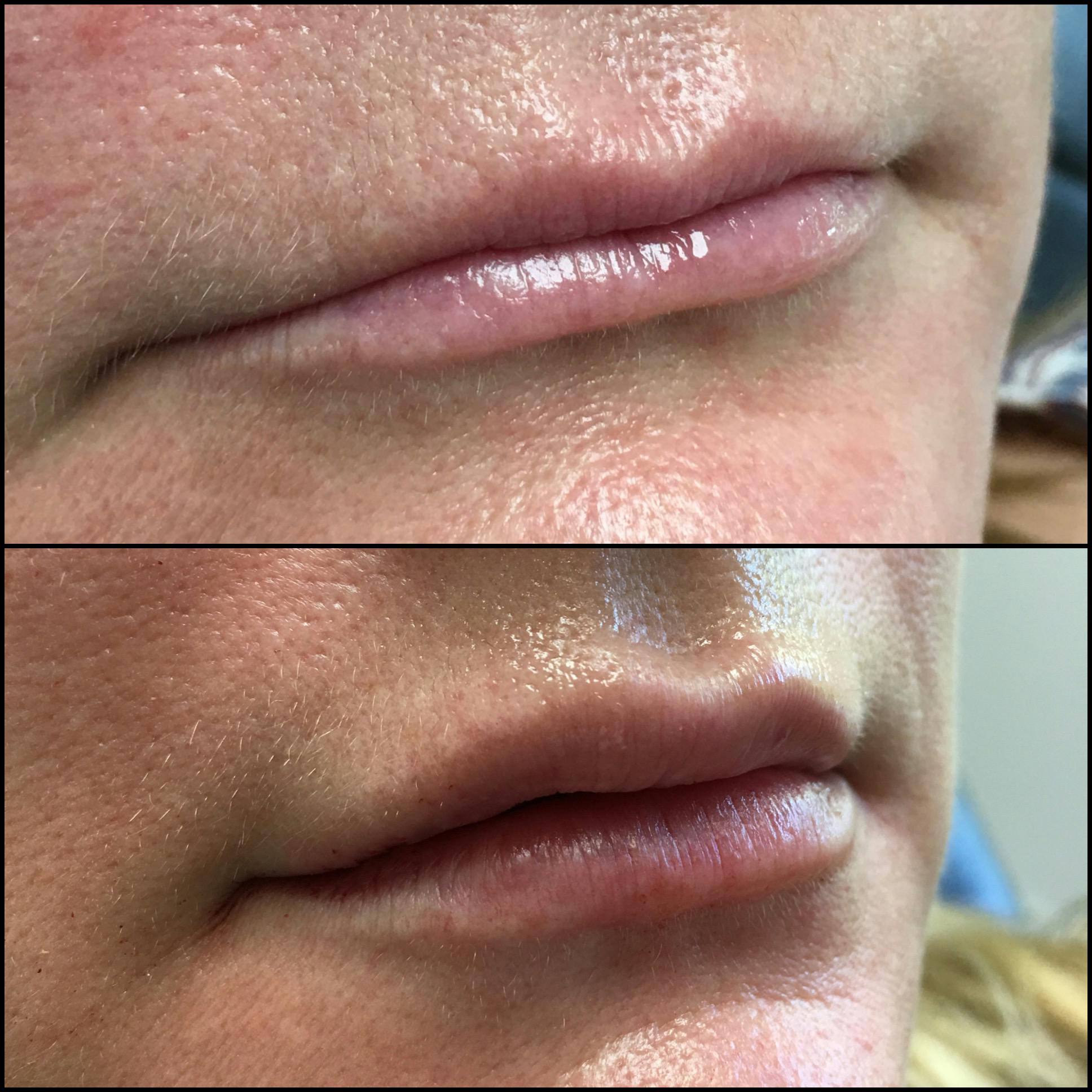 Lip Enhancement Gallery - Patient 62121542 - Image 1