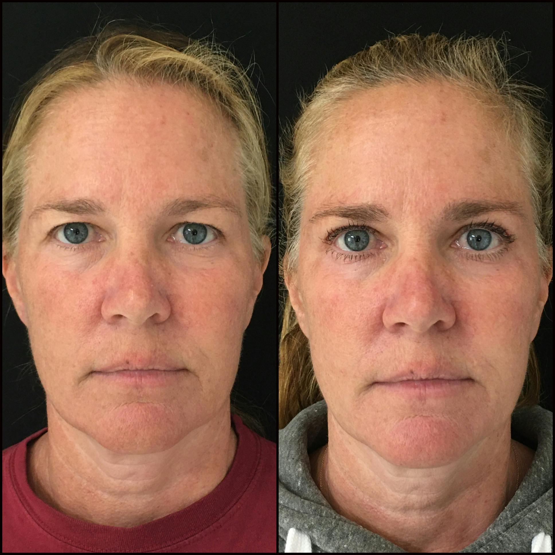 Upper Blepharoplasty Before & After Gallery - Patient 64243946 - Image 4