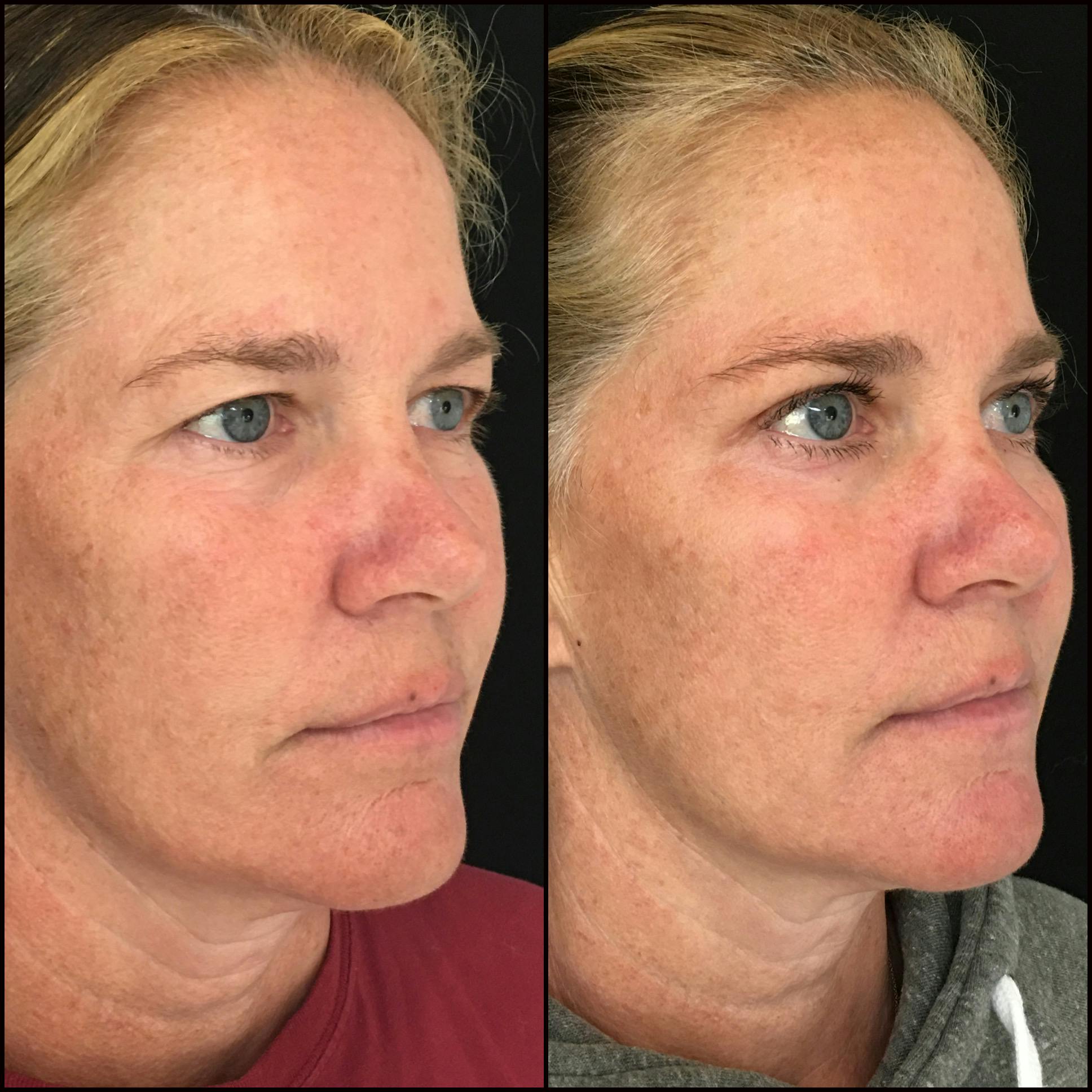Upper Blepharoplasty Before & After Gallery - Patient 64243946 - Image 6