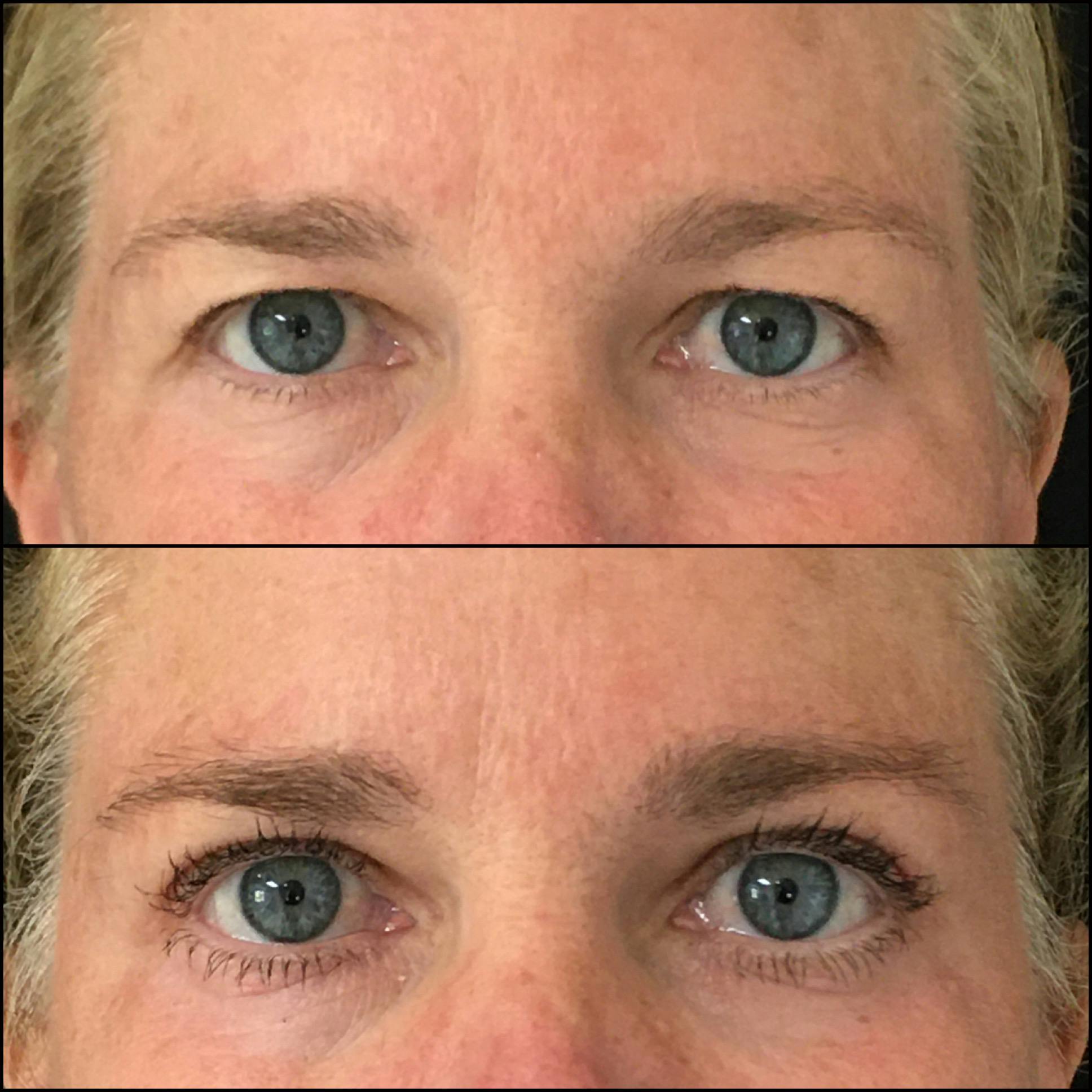 Upper Blepharoplasty Before & After Gallery - Patient 64243946 - Image 1