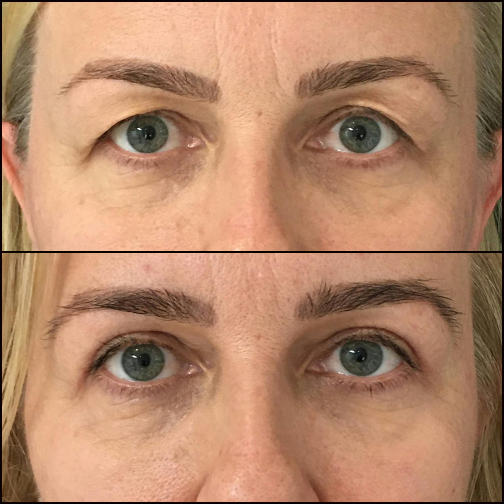 Upper Blepharoplasty Before & After Gallery - Patient 68492548 - Image 1