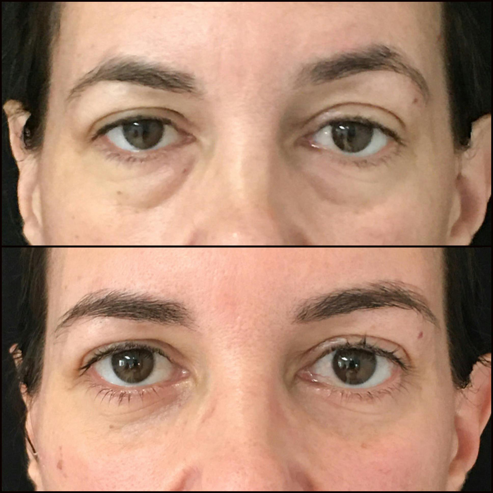 Lower Blepharoplasty Before & After Gallery - Patient 68493509 - Image 1