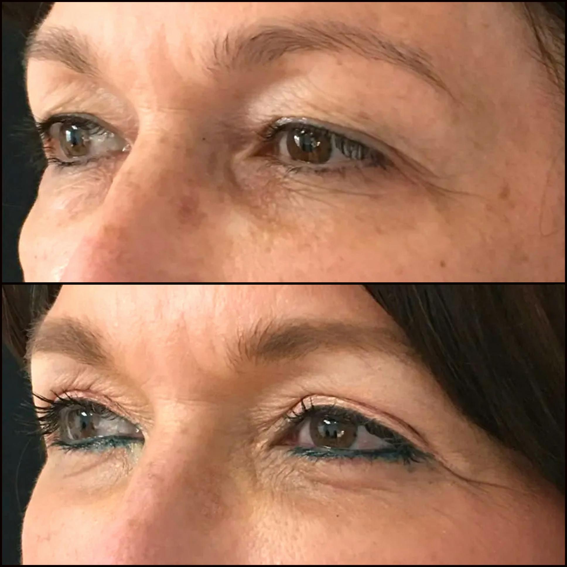 Upper Blepharoplasty Before & After Gallery - Patient 53591722 - Image 1