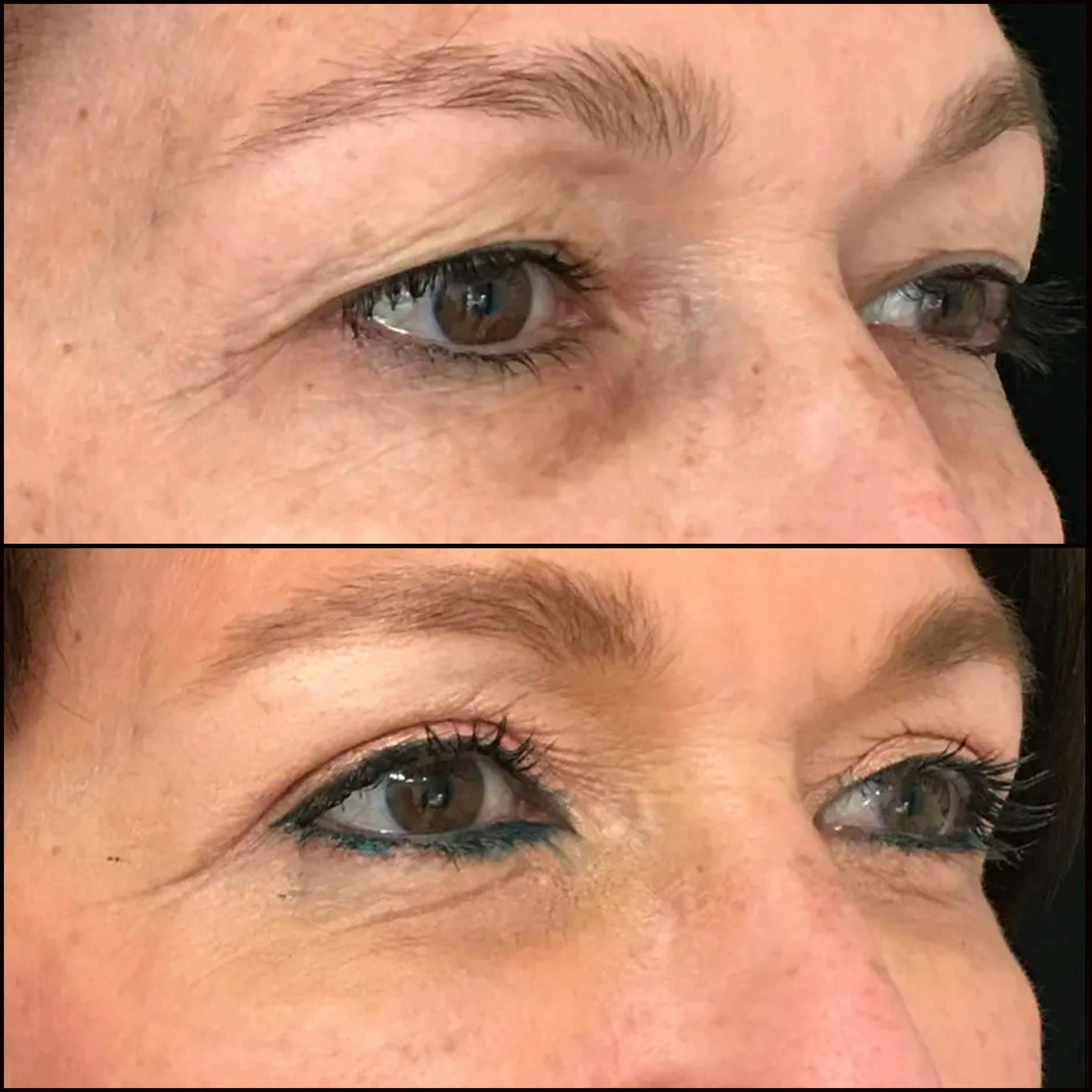 Upper Blepharoplasty Before & After Gallery - Patient 53591722 - Image 2