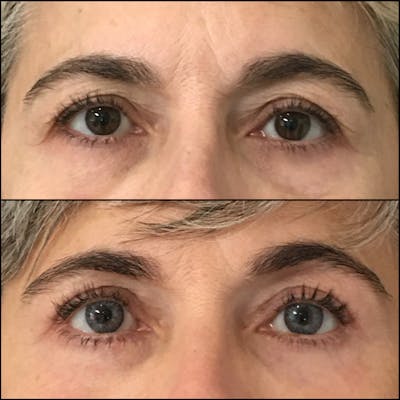 Upper Blepharoplasty Before & After Gallery - Patient 71249340 - Image 1