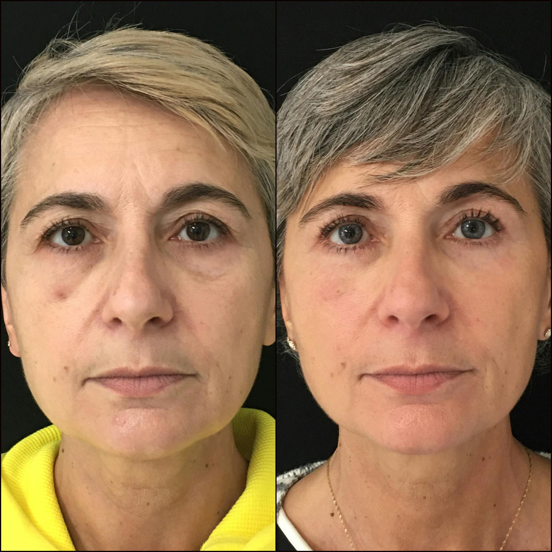 Upper & Lower Blepharoplasty<br> with Fat Transfer Gallery - Patient 71249392 - Image 1