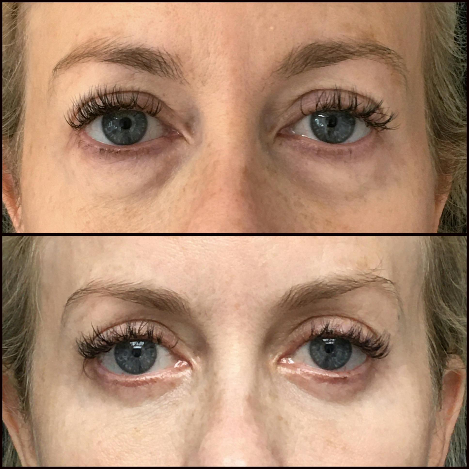 Upper & Lower Blepharoplasty Before & After Gallery - Patient 71343786 - Image 1