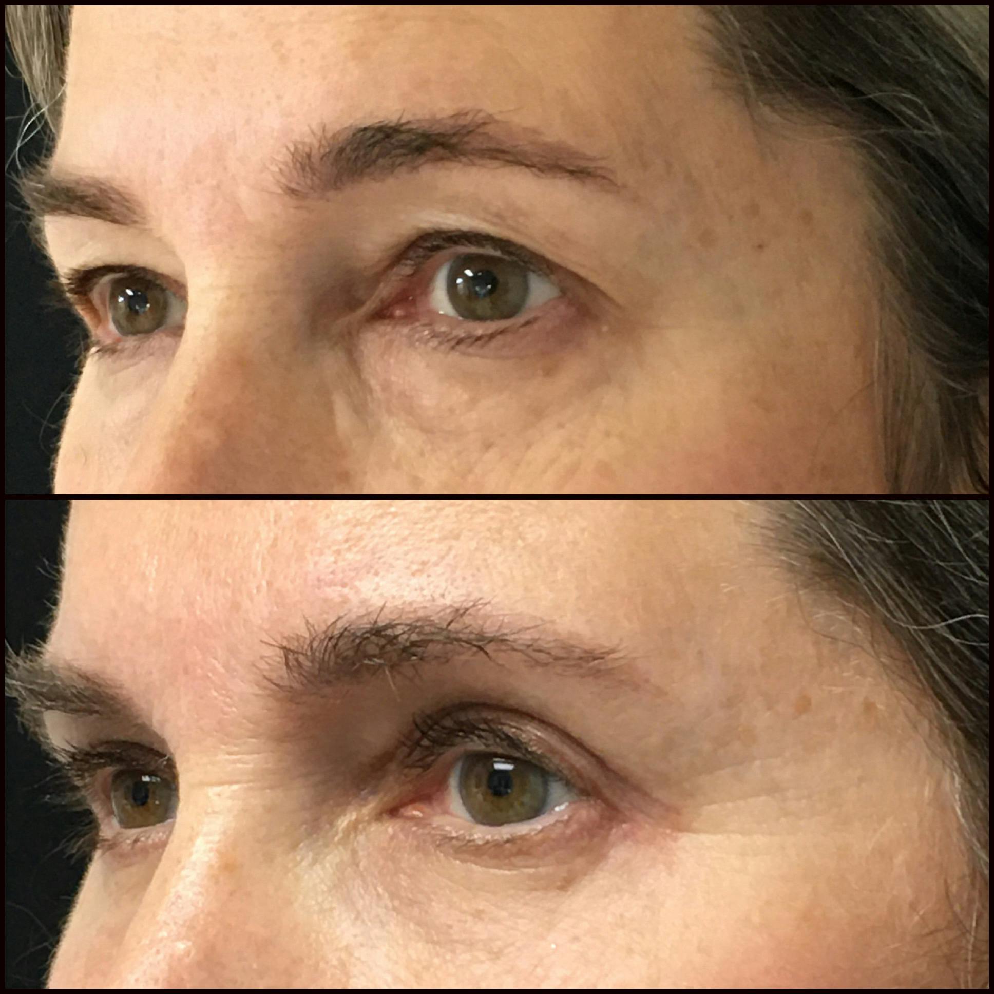 Upper & Lower Blepharoplasty Before & After Gallery - Patient 71344063 - Image 2