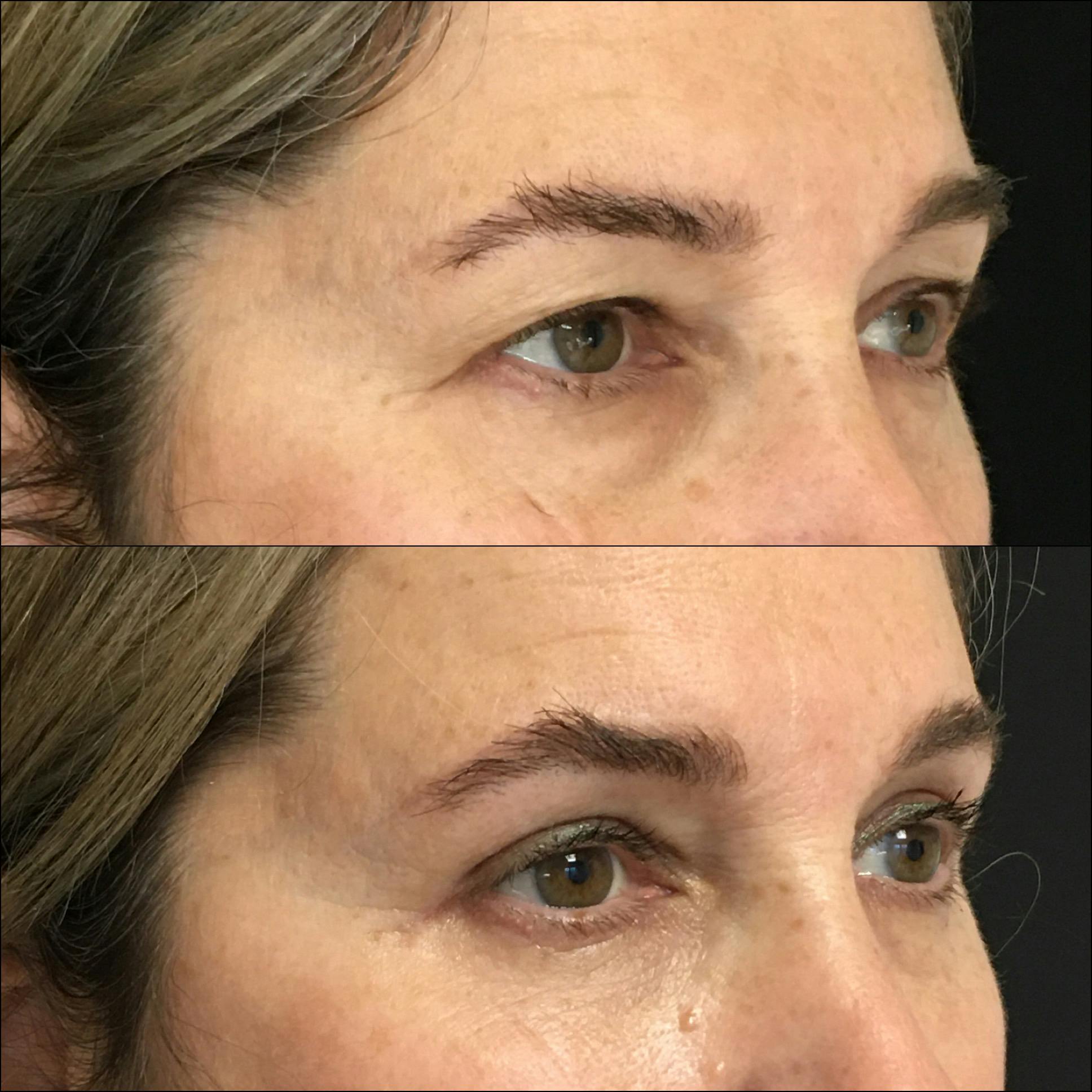 Lower Blepharoplasty Gallery - Patient 77163701 - Image 2