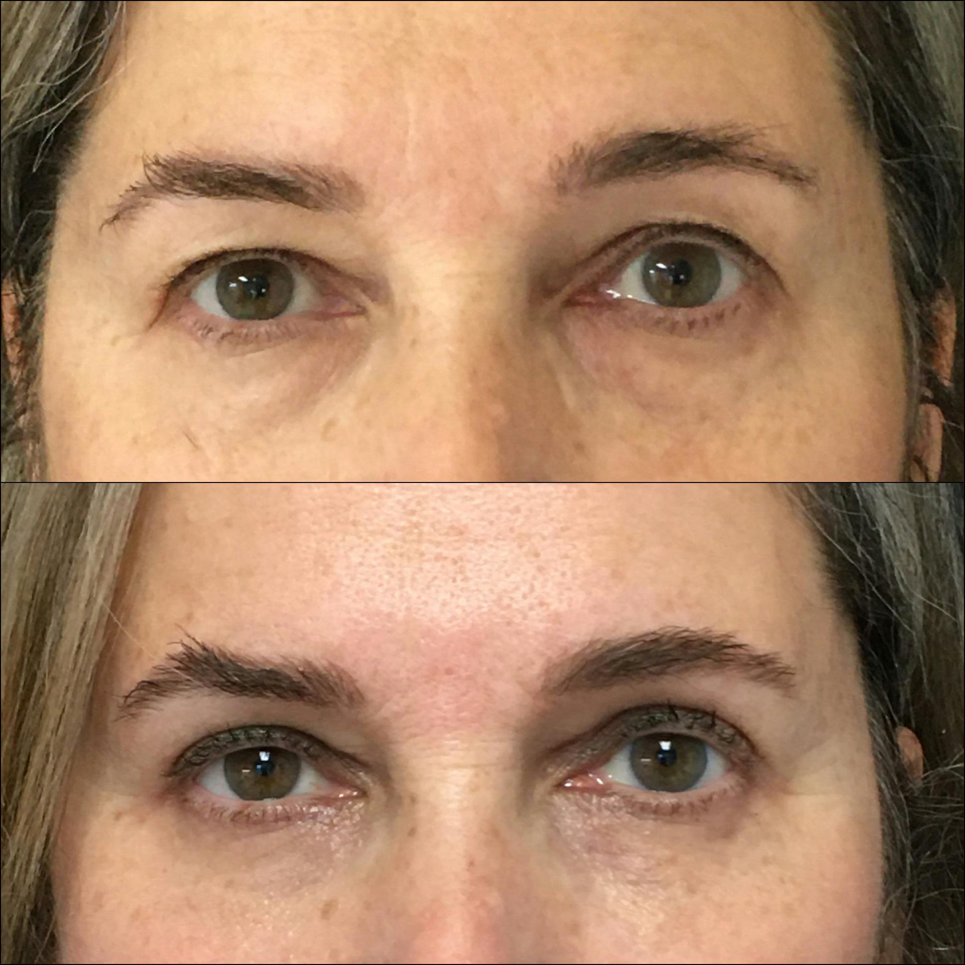 Lower Blepharoplasty Gallery - Patient 77163701 - Image 1