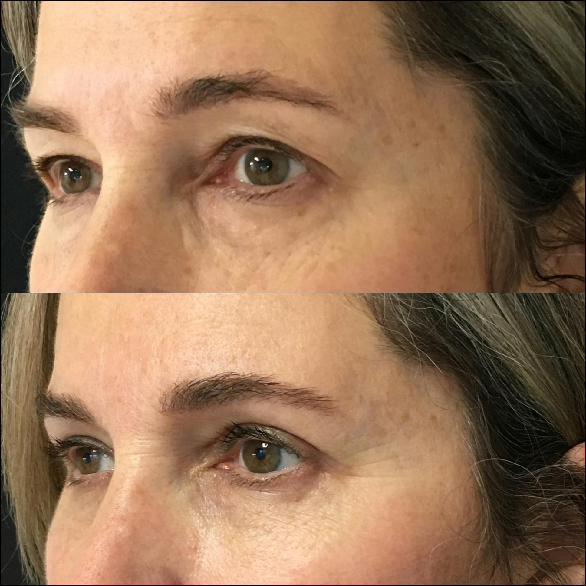 Lower Blepharoplasty Gallery - Patient 77163701 - Image 3