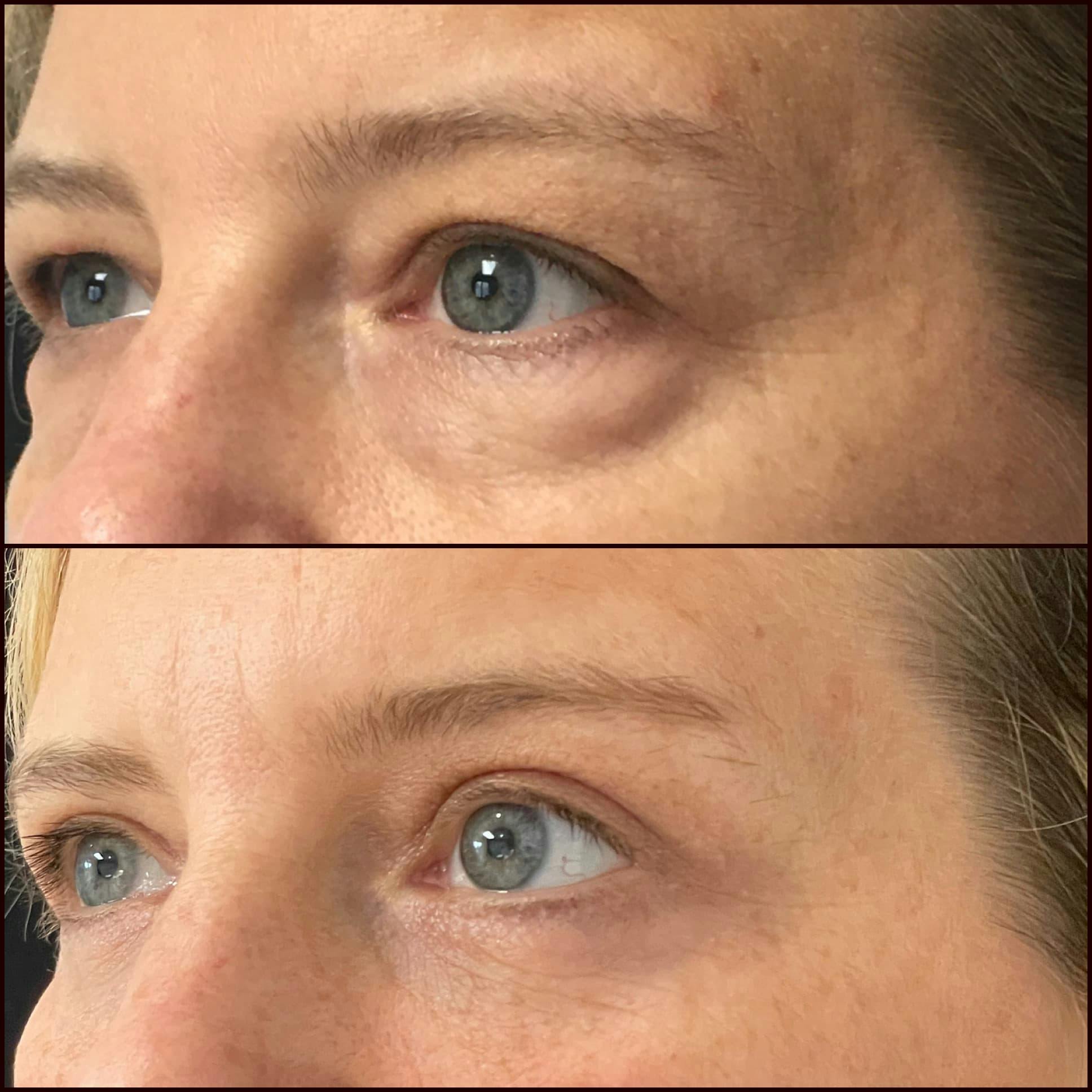 Upper & Lower Blepharoplasty Before & After Gallery - Patient 86224412 - Image 2
