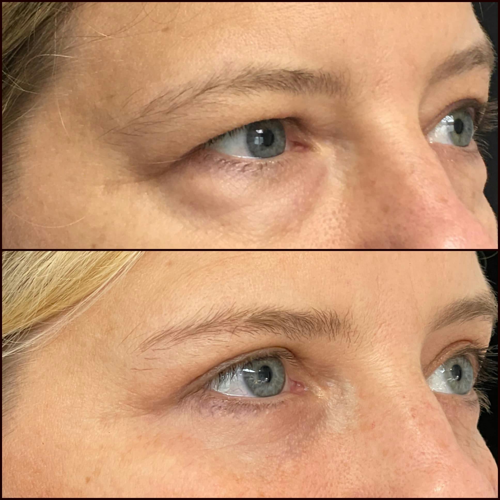 Upper & Lower Blepharoplasty<br> with Fat Transfer Gallery - Patient 86224412 - Image 1