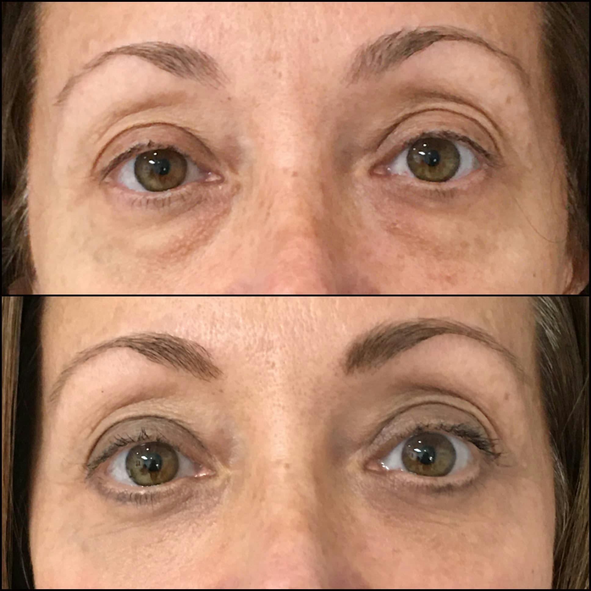Lower Blepharoplasty Before & After Gallery - Patient 141228595 - Image 1