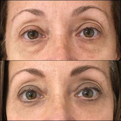 Lower Blepharoplasty Before & After Gallery - Patient 141228595 - Image 1