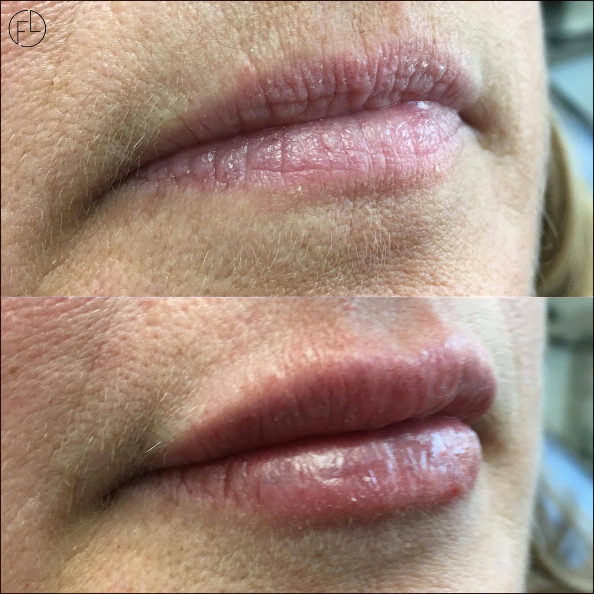 Lip Enhancement Before & After Gallery - Patient 105177705 - Image 1
