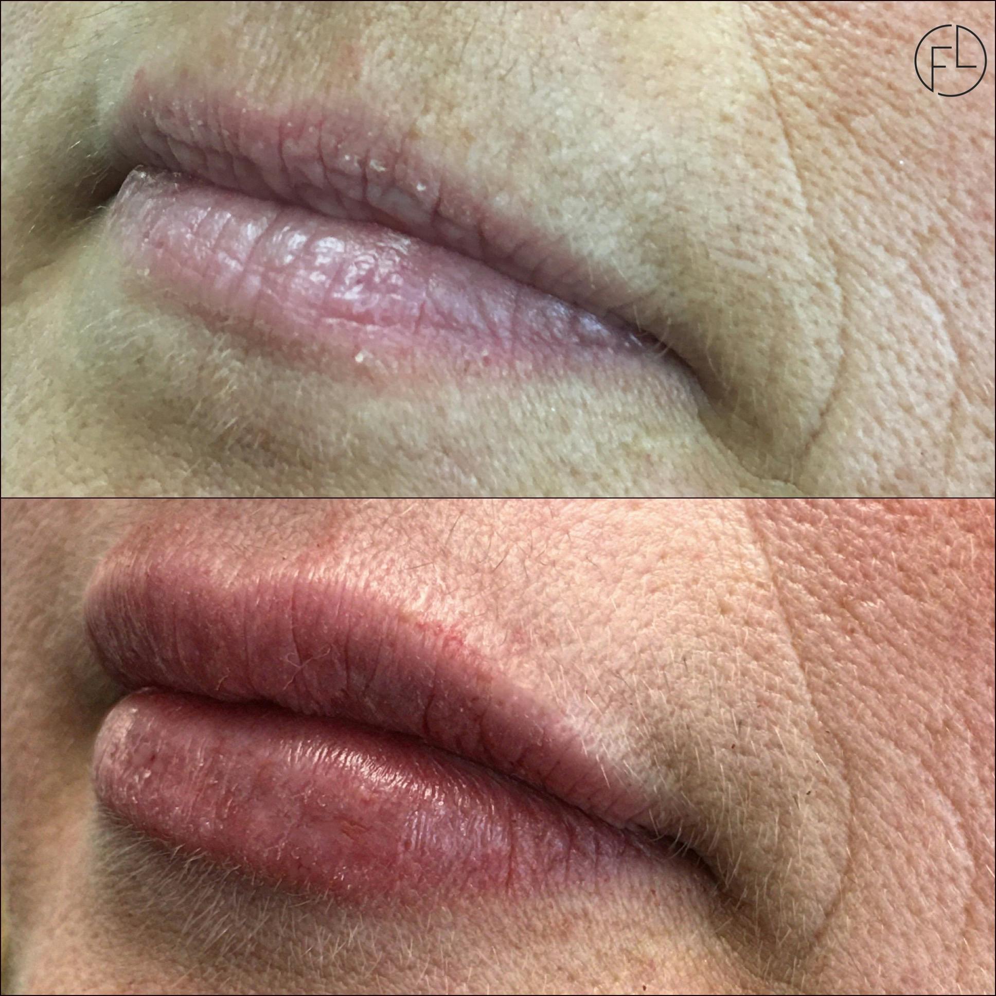 Lip Enhancement Before & After Gallery - Patient 105177705 - Image 2