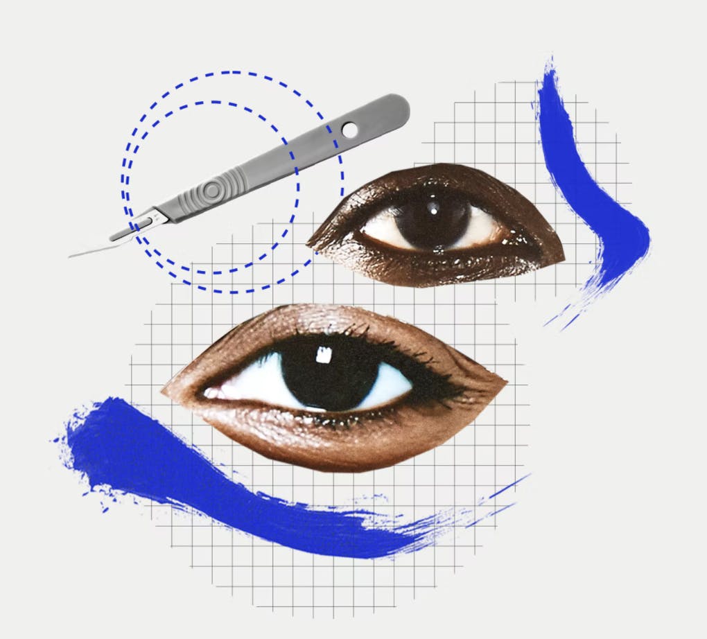Everything You Need To Know About The Buzzy Eyelid Lift Procedure