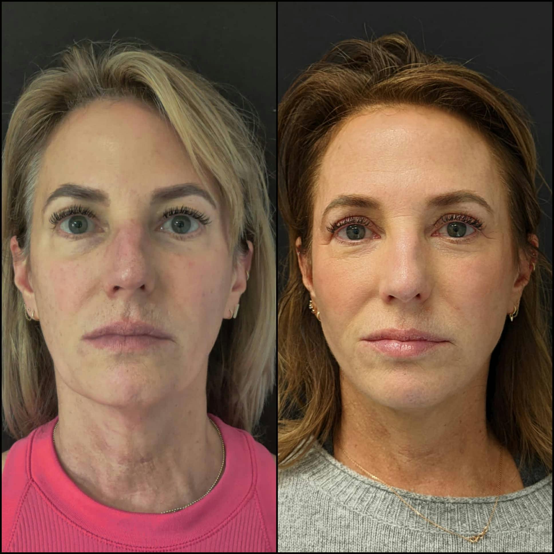 Upper Blepharoplasty Before & After Gallery - Patient 120942514 - Image 1