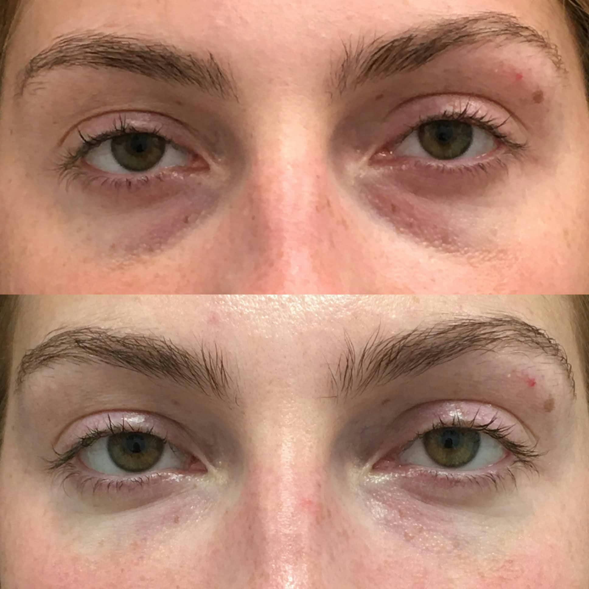 Eyelid Filler Before & After Gallery - Patient 120943113 - Image 1