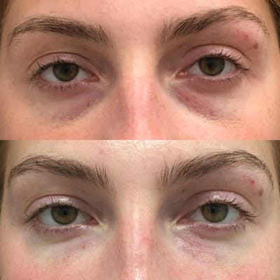 Eyelid Filler Before & After Gallery - Patient 120943113 - Image 1