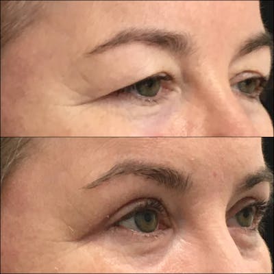 Upper Blepharoplasty Before & After Gallery - Patient 120943142 - Image 1