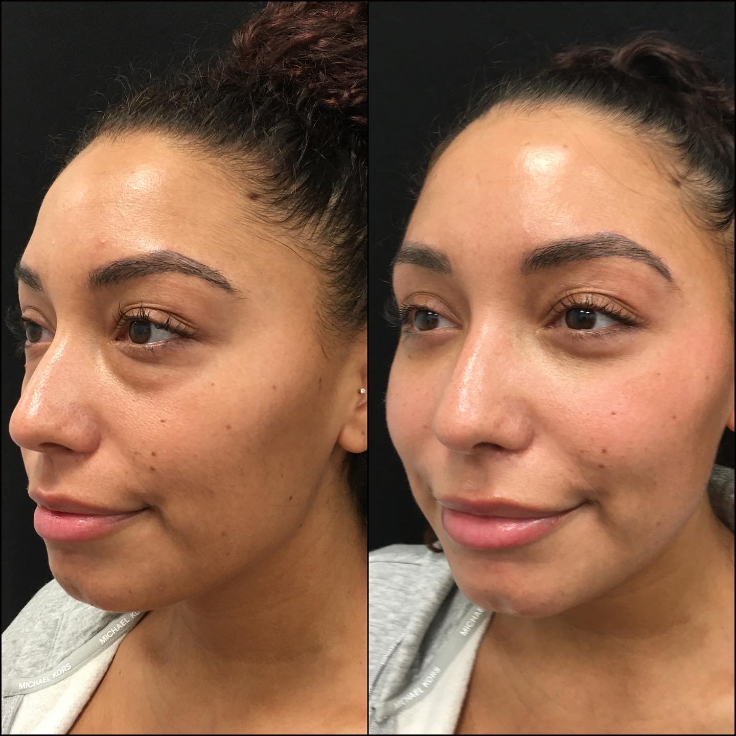 Lower Blepharoplasty Before & After Photos Flora Levin MD