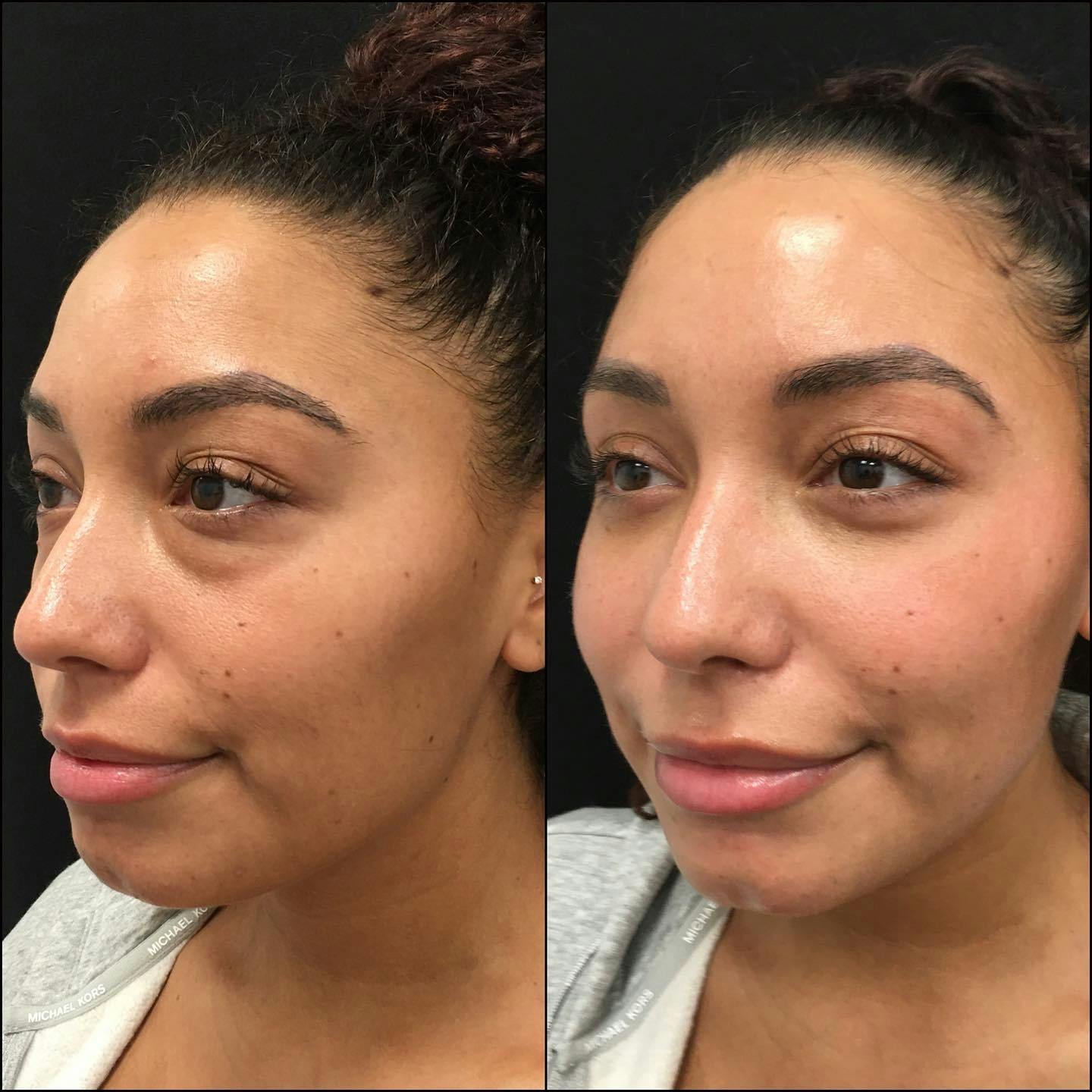 Lower Blepharoplasty Before & After Gallery - Patient 120943194 - Image 3