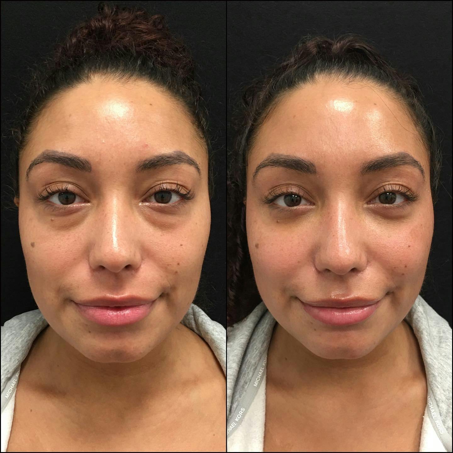 Lower Blepharoplasty Before & After Gallery - Patient 120943194 - Image 1