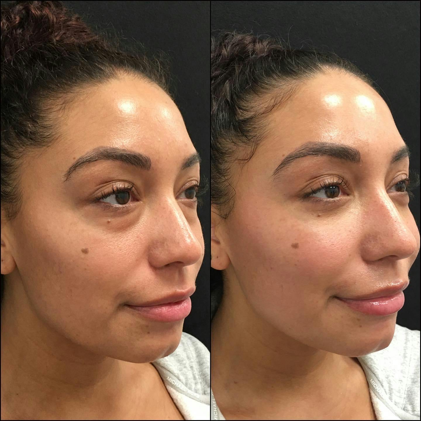 Lower Blepharoplasty Before & After Gallery - Patient 120943194 - Image 2