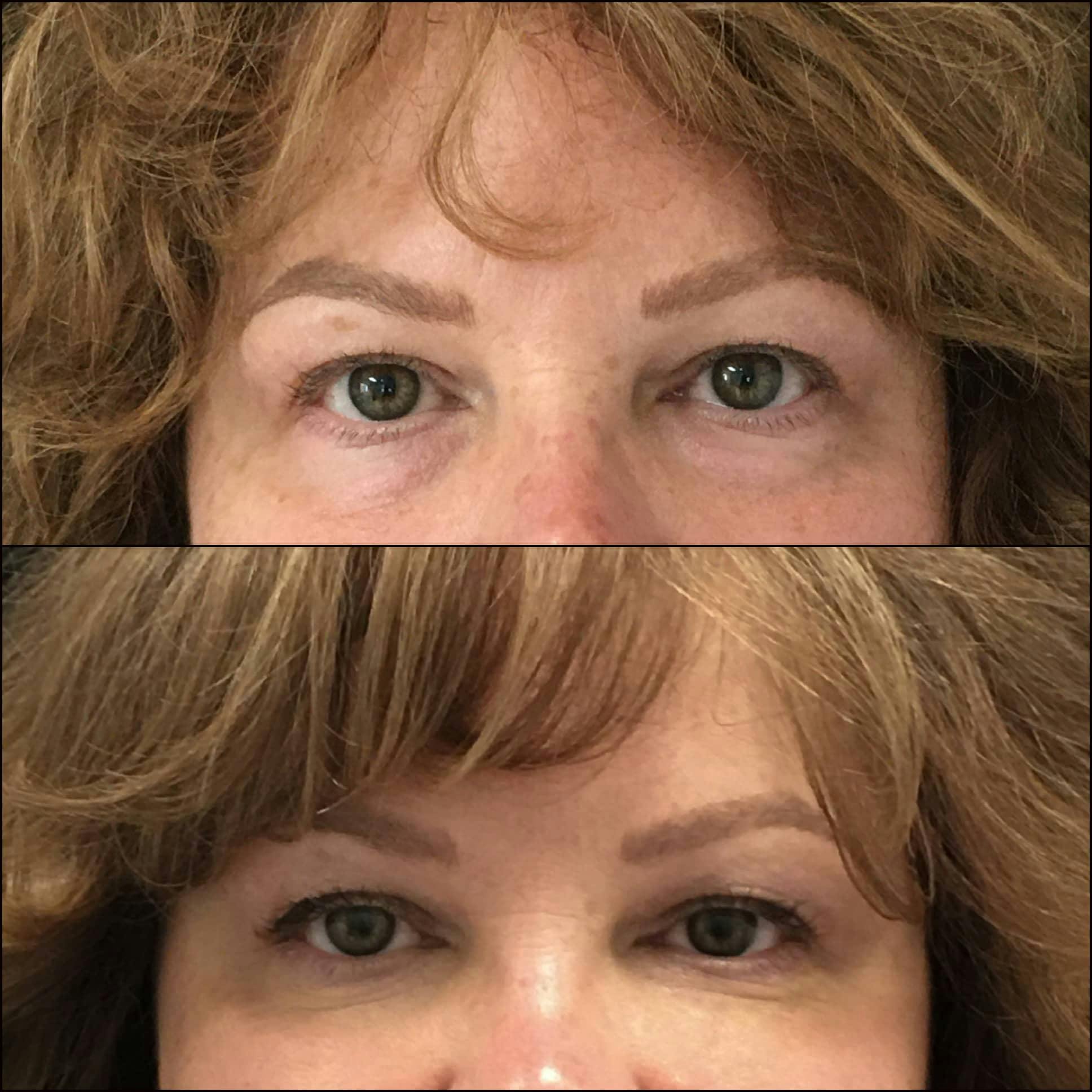 Lower Blepharoplasty Before & After Gallery - Patient 120943232 - Image 1