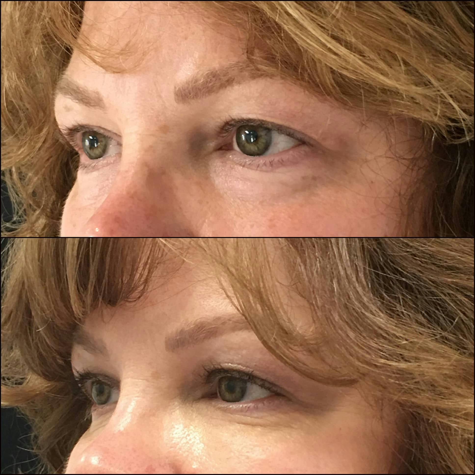 Lower Blepharoplasty Before & After Gallery - Patient 120943232 - Image 2