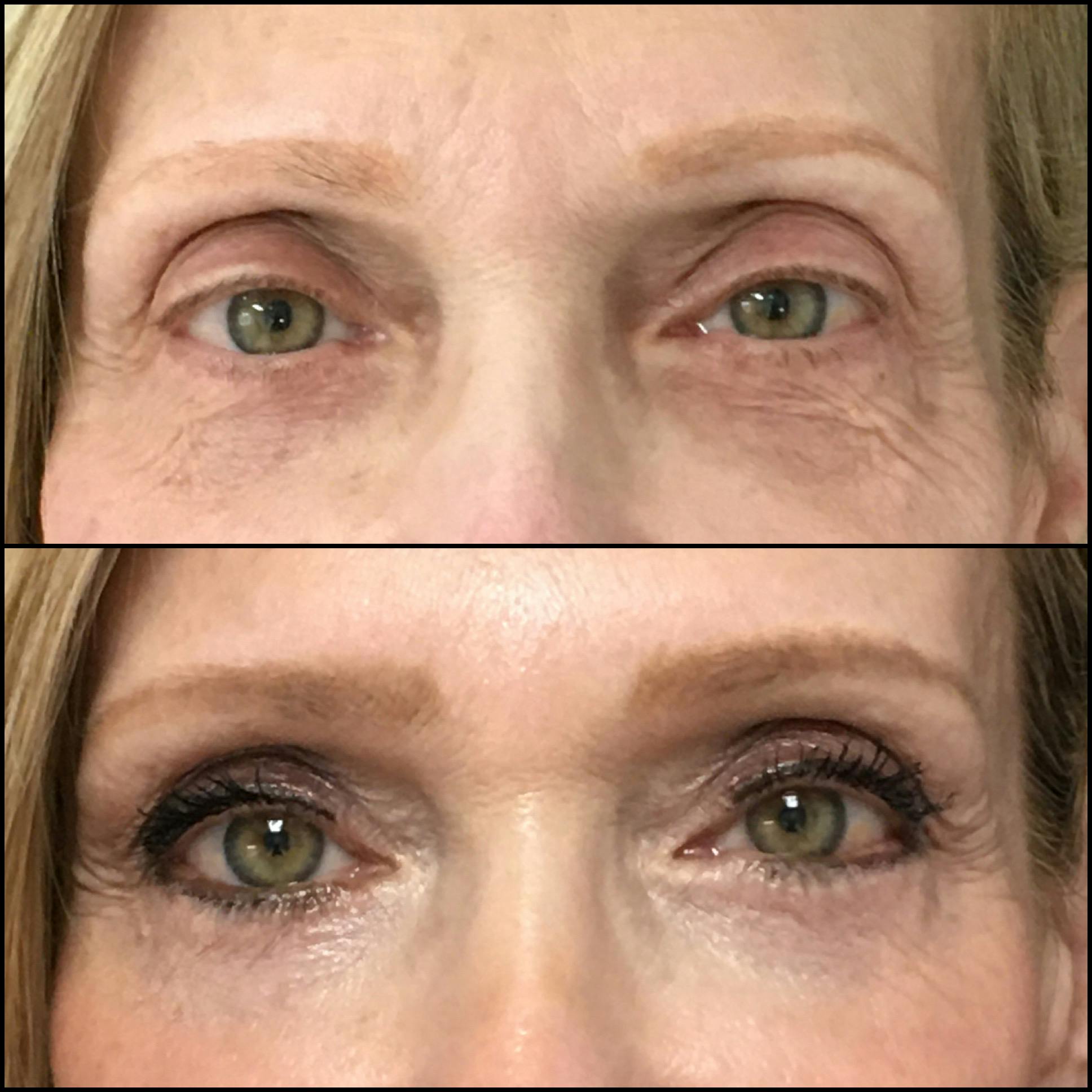 Lower Blepharoplasty Before & After Gallery - Patient 121162000 - Image 1