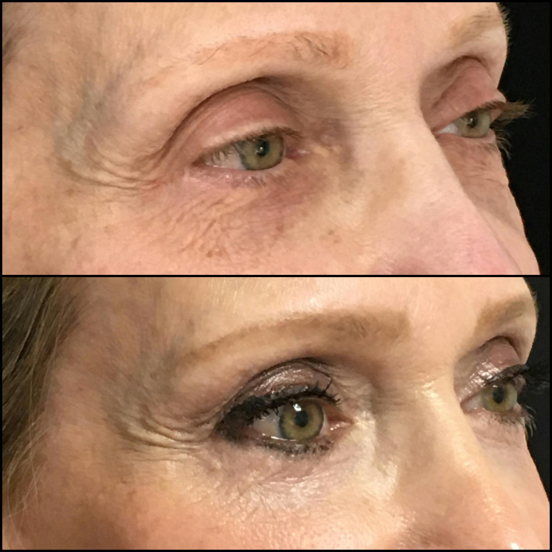 Lower Blepharoplasty Before & After Gallery - Patient 121162000 - Image 2