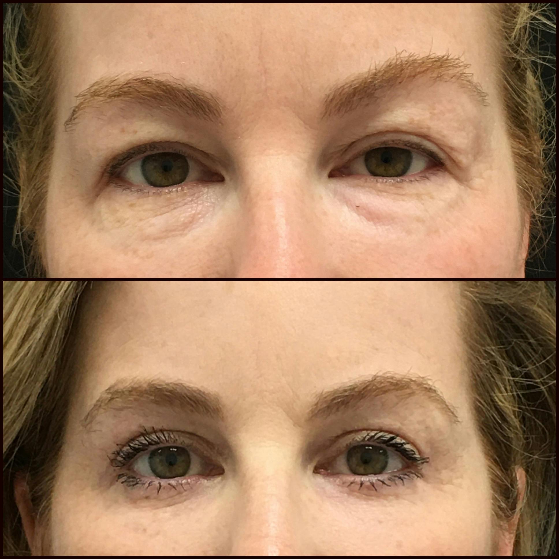 Lower Blepharoplasty Before & After Gallery - Patient 121162859 - Image 1