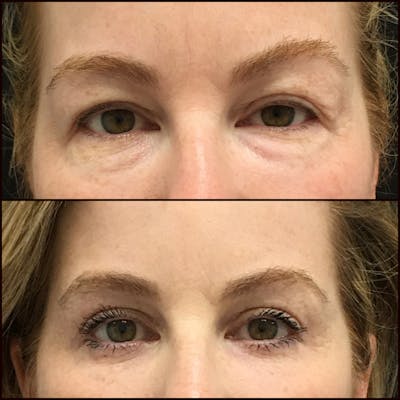 Upper Blepharoplasty Before & After Gallery - Patient 121162861 - Image 1