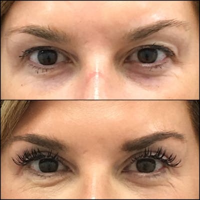 Upper Blepharoplasty Before & After Gallery - Patient 121844653 - Image 1