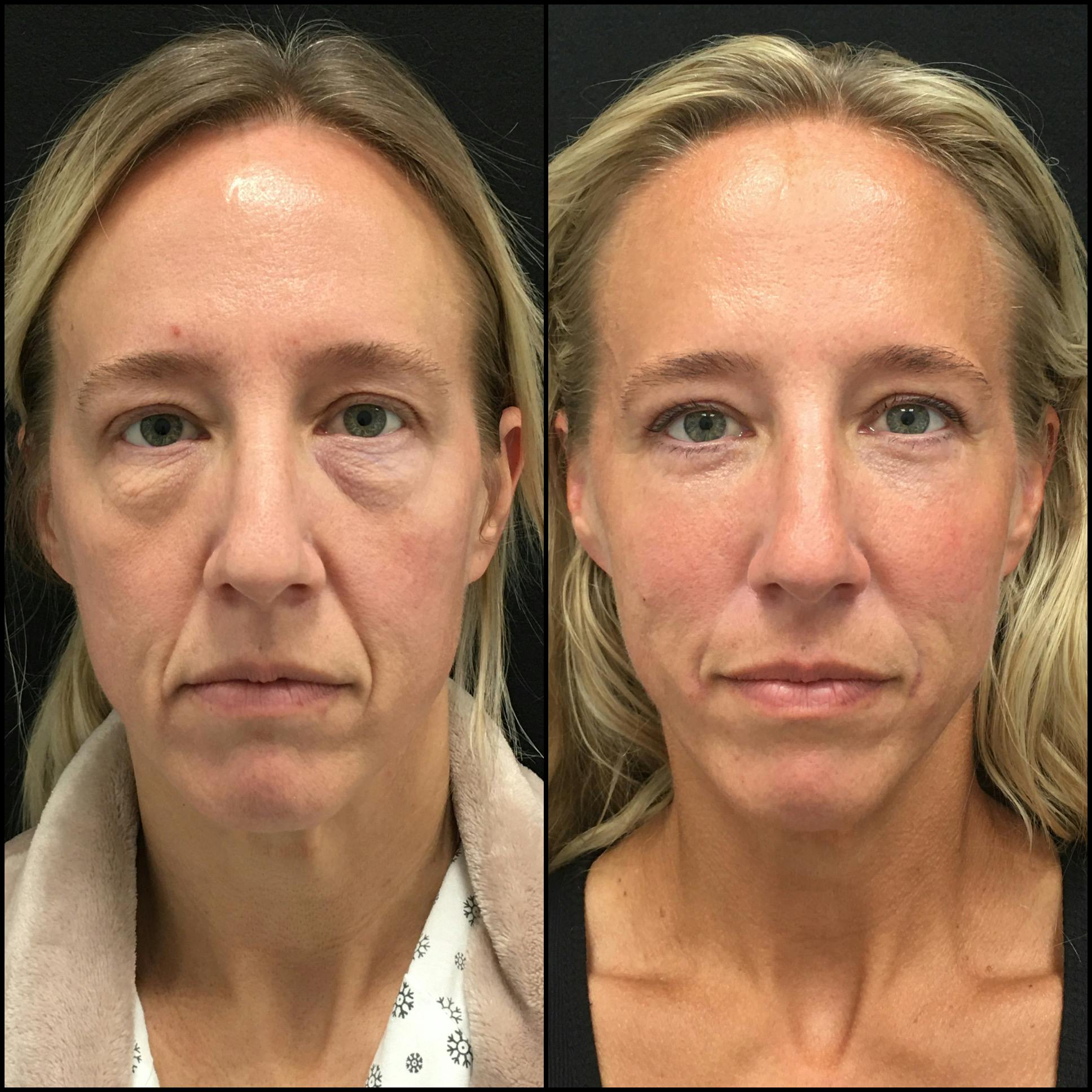 Lower Blepharoplasty Before & After Photos