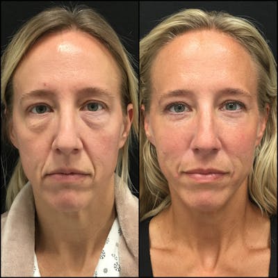 Lower Blepharoplasty Before & After Gallery - Patient 122771071 - Image 1