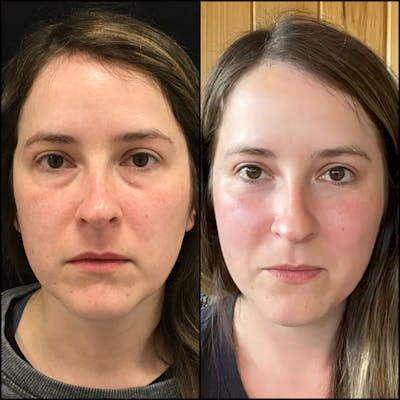 Lower Blepharoplasty Before & After Gallery - Patient 122771098 - Image 1